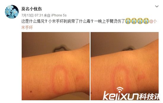 小米手環(huán)燙傷用戶？ 真假難辨誰之過